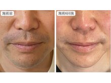 トパーズ 藤枝店(Topaz)/メンズ脱毛 ヒゲ脱毛 藤枝