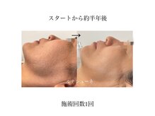 当店は都度払いのみとなりコース販売は行っておりません。