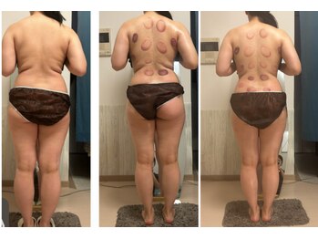 オーシャンブルーム 目黒(OceanBloom)/リンパマッサージハイパーナイフ