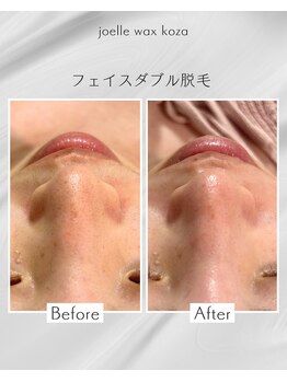 ジョエルワックス 沖縄コザ店(JOELLE WAX)/フェイスダブル脱毛☆