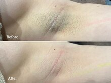 フェイシャルクレア(Cre A.)/脇脱毛【Sパーツ】