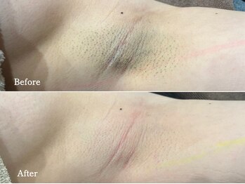 フェイシャルクレア(Cre A.)/脇脱毛【Sパーツ】