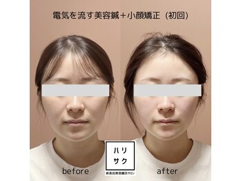 ハリサク/施術写真