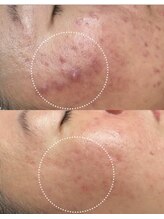 ミャオ(Meow!)/赤いニキビ、ニキビのあと