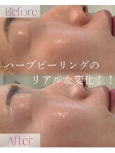 モア 星ヶ丘店(MORE)/ハーブピーリング