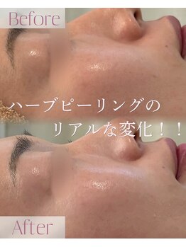 モア 星ヶ丘店(MORE)/ハーブピーリング