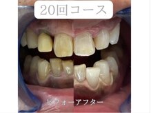 ホワイトニングショップ 亀岡店/【ビフォーアフター】美白