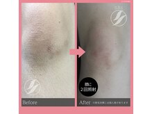 アイリ(AIRI)/エステ脱毛