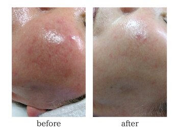 りりあす/血行不良を改善して赤ら顔解消!