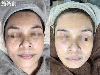 エミルカ(EMILUCA)/ハーブピーリングでシミ改善