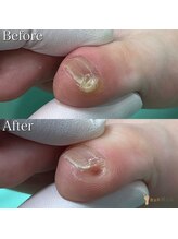 巻き爪補正店 つくば店/【副爪ケア】