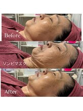 オルオル 天神大名店(Olu-.olu.)/ゾンビマスク/天然BTX/小顔