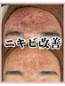 【ニキビケア】剥離なしハーブピーリング90分¥14,300→9300