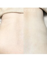 エミュ(emu)/背中wax＋光脱毛