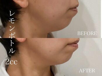 エミュ(emu)/脂肪分解話題のレモンボトル!!