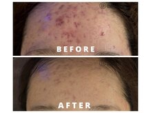 LDM水玉リフティングでニキビケア/肌質改善/跡ケアもおまかせ