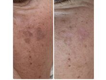 ソワンマリア(soin Maria)/ホワイトラボのシミケア