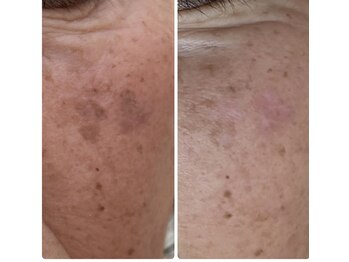 ソワンマリア(soin Maria)/ホワイトラボのシミケア