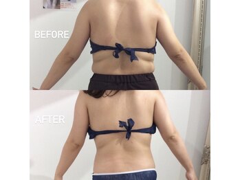 エスグレース 梅田店(S.grace)/背中美人に！