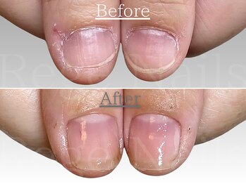 自爪育成・深爪改善コース