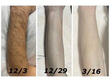 クリスタルボウ(Crystal BEAU)/メンズ脱毛(腕毛)4回