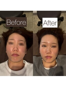 東京デトックス/インディバ小顔頭蓋骨調整60分