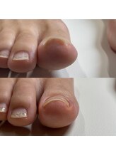 リリ(lili)/巻き爪矯正/1回目