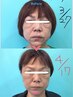【平日限定】小顔矯正（鍼による）６０分or美容鍼６０分【判断分析付】