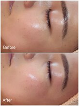 イーズ(eees)/ウルツヤ毛穴ケアの施術後