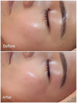 イーズ(eees)/ウルツヤ毛穴ケアの施術後