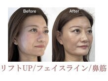 ラプリ 札幌ル・トロワ店/隆鼻＋輪郭矯正40分　10回