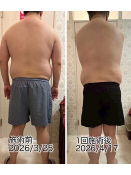 クールスパ(COOL SPA)/男性背中症例