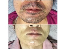 トータルメンズエステ キング(KING)の雰囲気（【茅ヶ崎唯一】美容電気脱毛取扱い！白髪・硬毛化お任せ下さい）