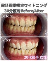 プラチナムビューティ 四条烏丸店(PLATINUM Beauty)/ホワイトニング！Before./After!