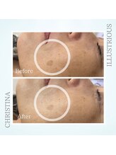 シャルムパリス(charme paris)/長年のシミにも◎１回の施術変化