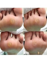 巻き爪補正店 つくば店/【硬いタコ/魚の目ケア】