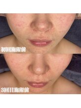 ルシェリア(Le cherien)/どちらも施術前ビフォーアフター