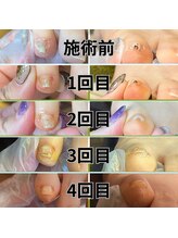 トトメス(thutmose)/巻き爪ケア