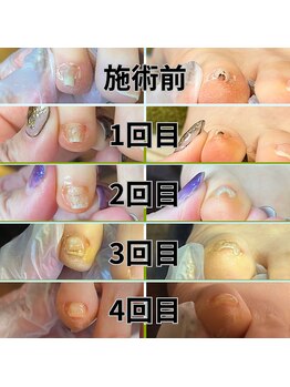 トトメス(thutmose)/巻き爪ケア