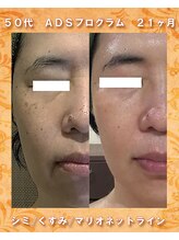 ナイア(naia)/リセラADS使用症例