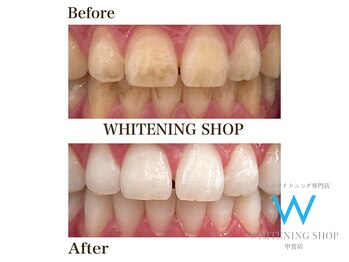 ホワイトニングショップ 甲賀店/Before&After『ホワイトニング』