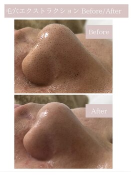 レミー(Remy)/毛穴エクストラクション