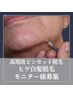 新メニュー♪【高周波ピンセット脱毛】45分ヒゲ白髪脱毛※モニター募集