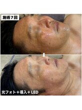 アンリミット(Unlimit)/複合施術で色ムラ.髭.小じわ改善