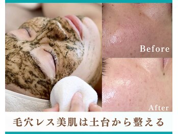シーズン(Season)の写真/ぽっかり毛穴、黒ずみ毛穴に！ハーブピーリング×コラーゲン産生マシンで引き締まった理想肌へ