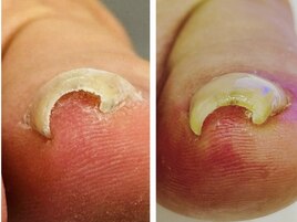 解放！巻き爪強制