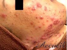 アクール(Accueil)/頑固な肌荒れに働きかけます！４