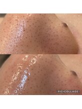 アトリエ ハルミナ(atelier harumina)/毛穴ケア・毛穴洗浄　三島エステ