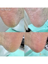 巻き爪補正店 つくば店/【かかとの角質ケア】