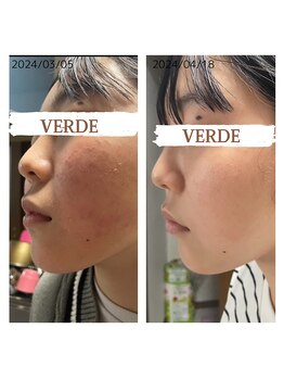 ヴェルデ 八尾/ニキビケア